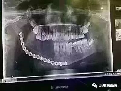 乳牙蛀牙清除真实全过程,小儿乳牙龋齿民间治疗偏方