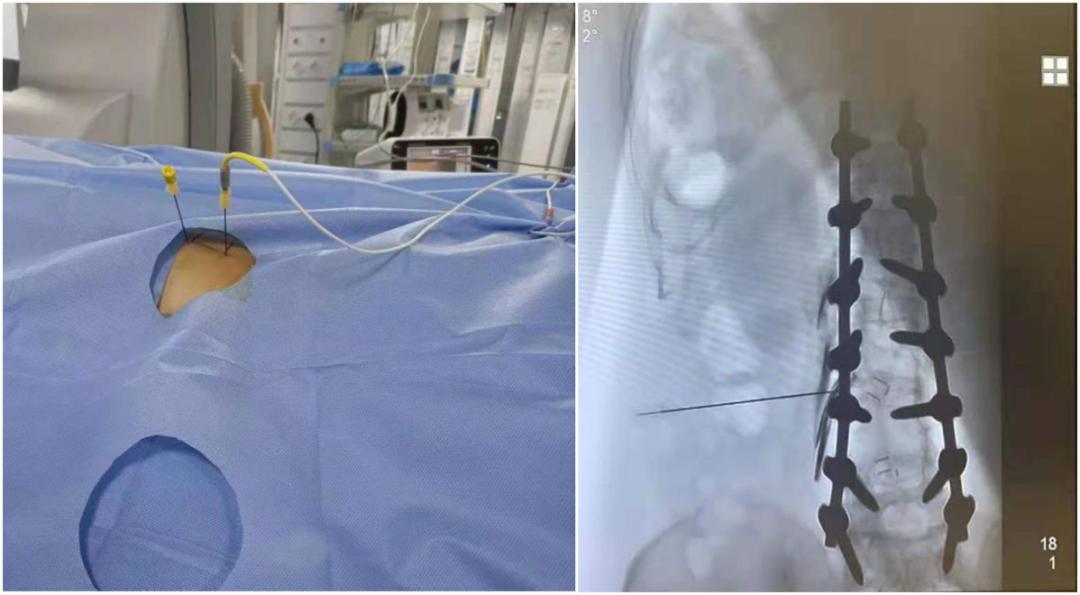 赶走疼痛，一身轻松！腰背痛，太原市中心医院疼痛科有妙招