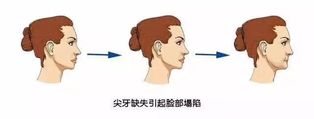 虎牙齿能不能拔,老虎牙可以拔掉吗