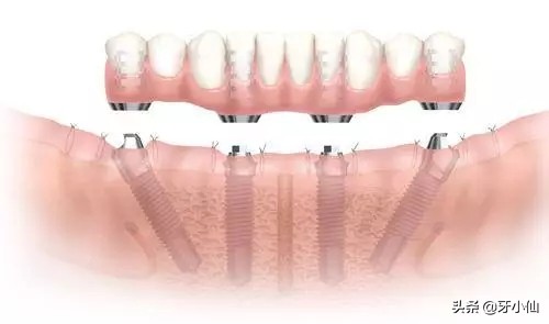 老人牙掉了种牙好还是镶牙好,老人半口牙都掉了做什么牙合适