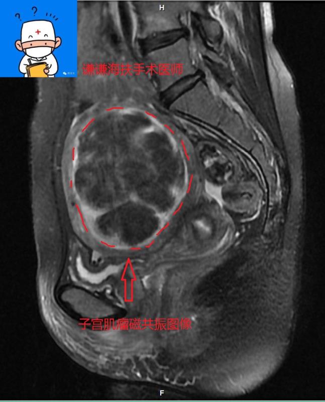子宫内膜肌瘤鉴别诊断,子宫肌瘤的鉴别诊断以及鉴别要点
