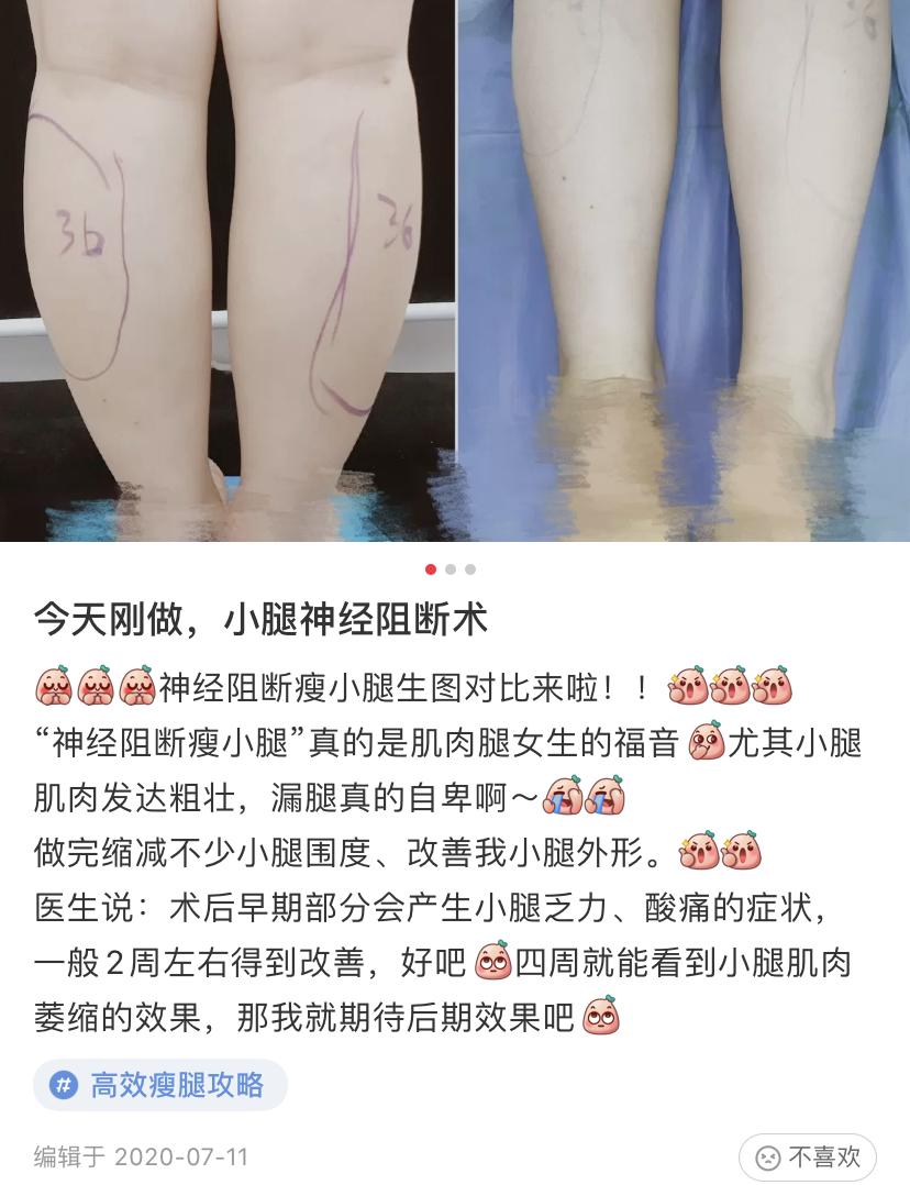 招风耳注射矫正,招风耳打针