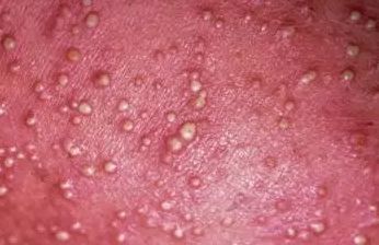 宝宝长痱子用什么方法最好,如何防止宝宝长痱子更有效