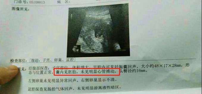 怀孕10周未见胚芽和胎心搏动,孕10周看不到胎心胎芽怎么回事