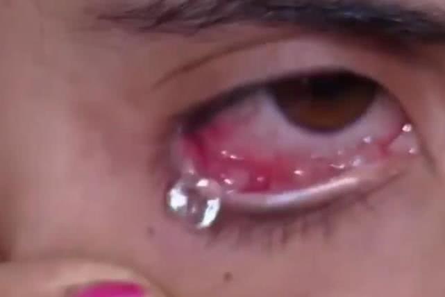 女子得了罕见怪病眼睛流出血,女子眼睛流出钻石眼泪