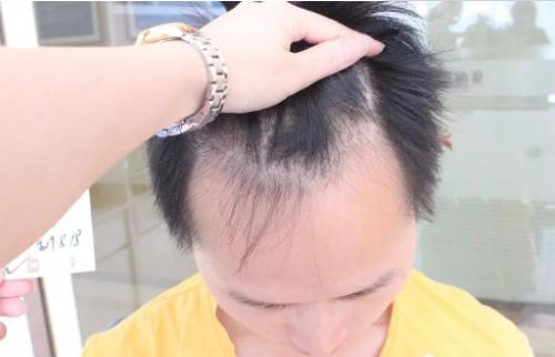 男性m型脱发是脂溢性脱发吗,m型脱发还在继续脱发怎么办