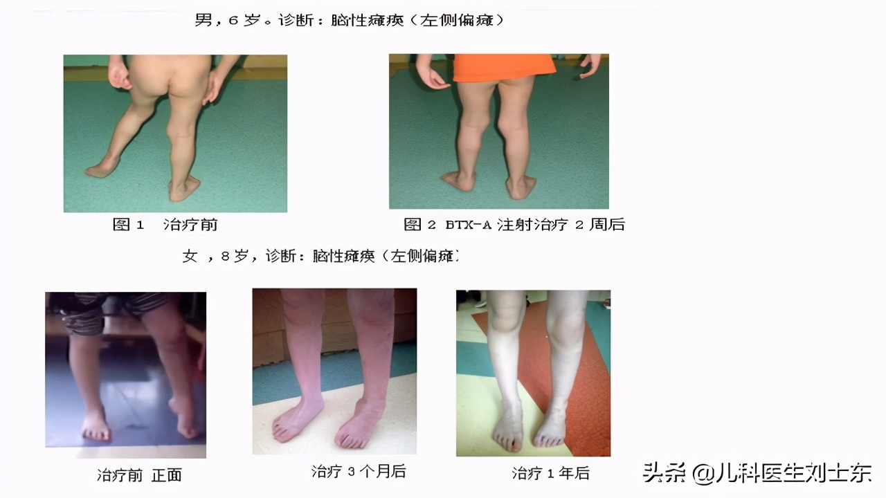 肉毒素治疗脑瘫患儿成功案例,肉毒素治疗脑瘫肌肉痉挛的效果