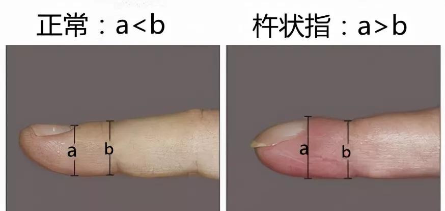 麦迪森健康提醒：手指末端莫名肿大！当心是疾病信号