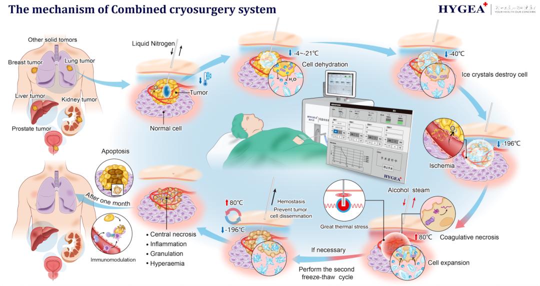 康博刀与氩氦刀区别,康博刀手术成功视频