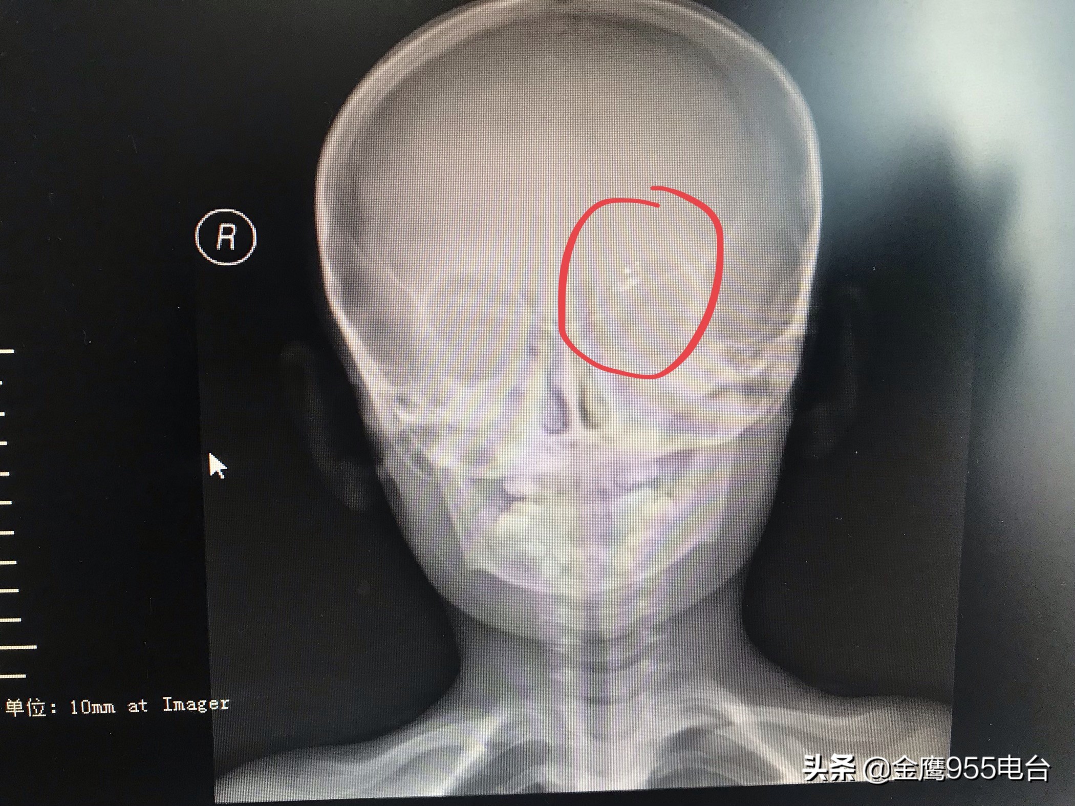 家长注意了!男孩不慎摔倒温度计插入眼眶三年驱汞治疗仍有残余