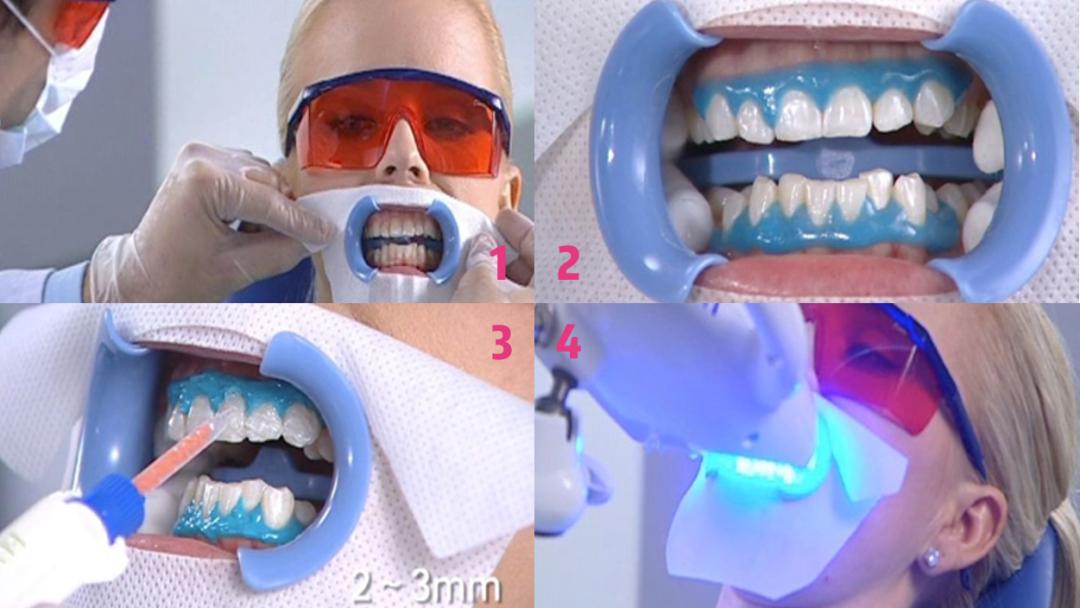 冷光美白牙齿危害亲身经历,牙齿美白科普篇