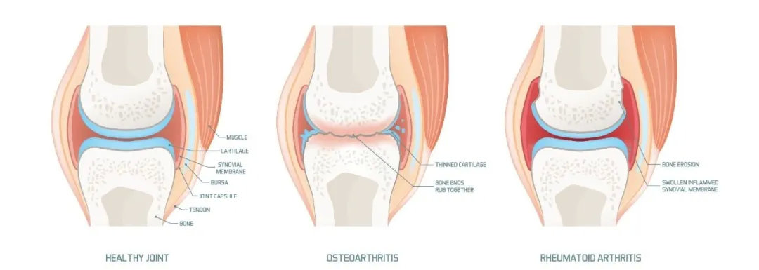 快讯|科学家利用胎盘干细胞来治疗早产儿结肠炎等多种疾病