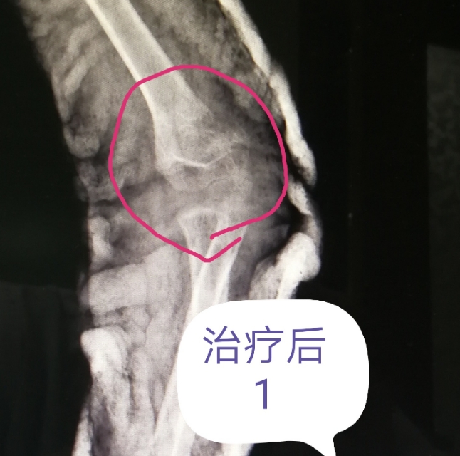 骨折的微创手术有后遗症吗,骨折的微创手术需要多少钱