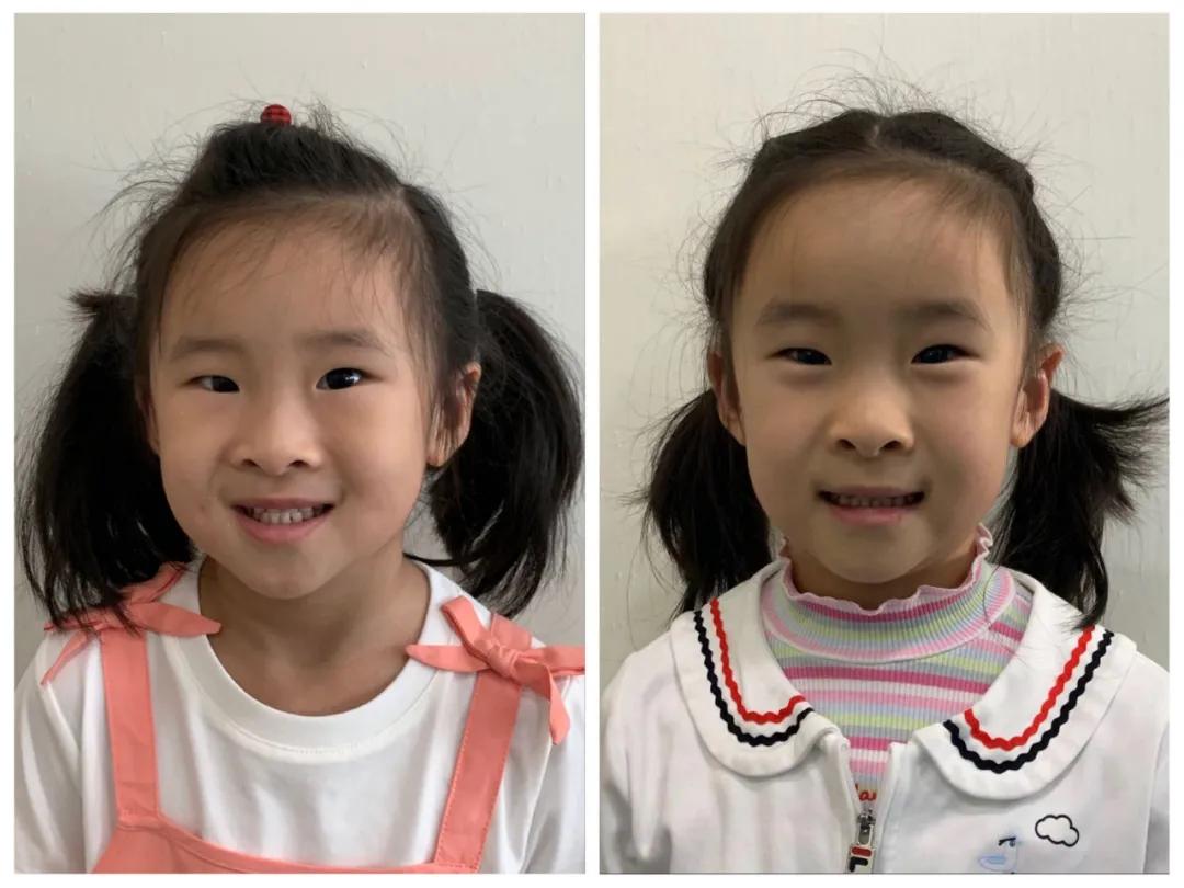 儿童牙咬合不正几岁矫正,儿童上牙反咬合正畸吃不了东西