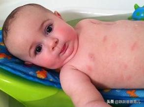 治疗湿疹的最好土办法除根,治疗湿疹图片