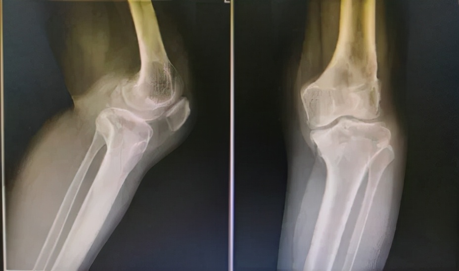股骨和胫骨双部位截骨拯救复杂膝关节内翻畸形