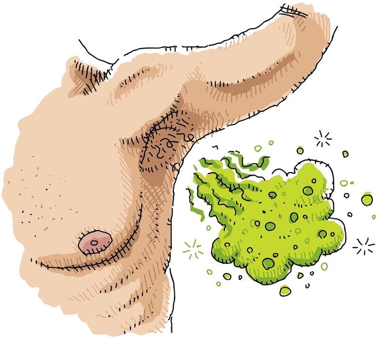 腋下有狐臭下体也有狐臭味,一抬手就闻到腋下的狐臭味