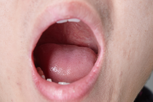 牙齿的黄泥是不是牙结石,牙齿内侧黑垢牙结石怎么处理