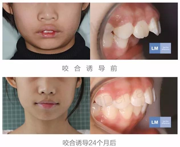 儿童牙齿早期干预矫正有几种,儿童牙齿早期矫正图片