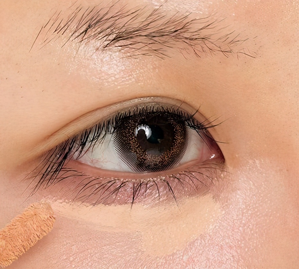 血管型黑眼圈怎么消除,戴眼镜黑眼圈怎么消除