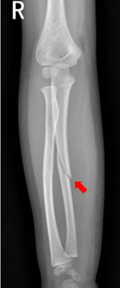 怎样发现骨折的可能性,一招看出手指骨折