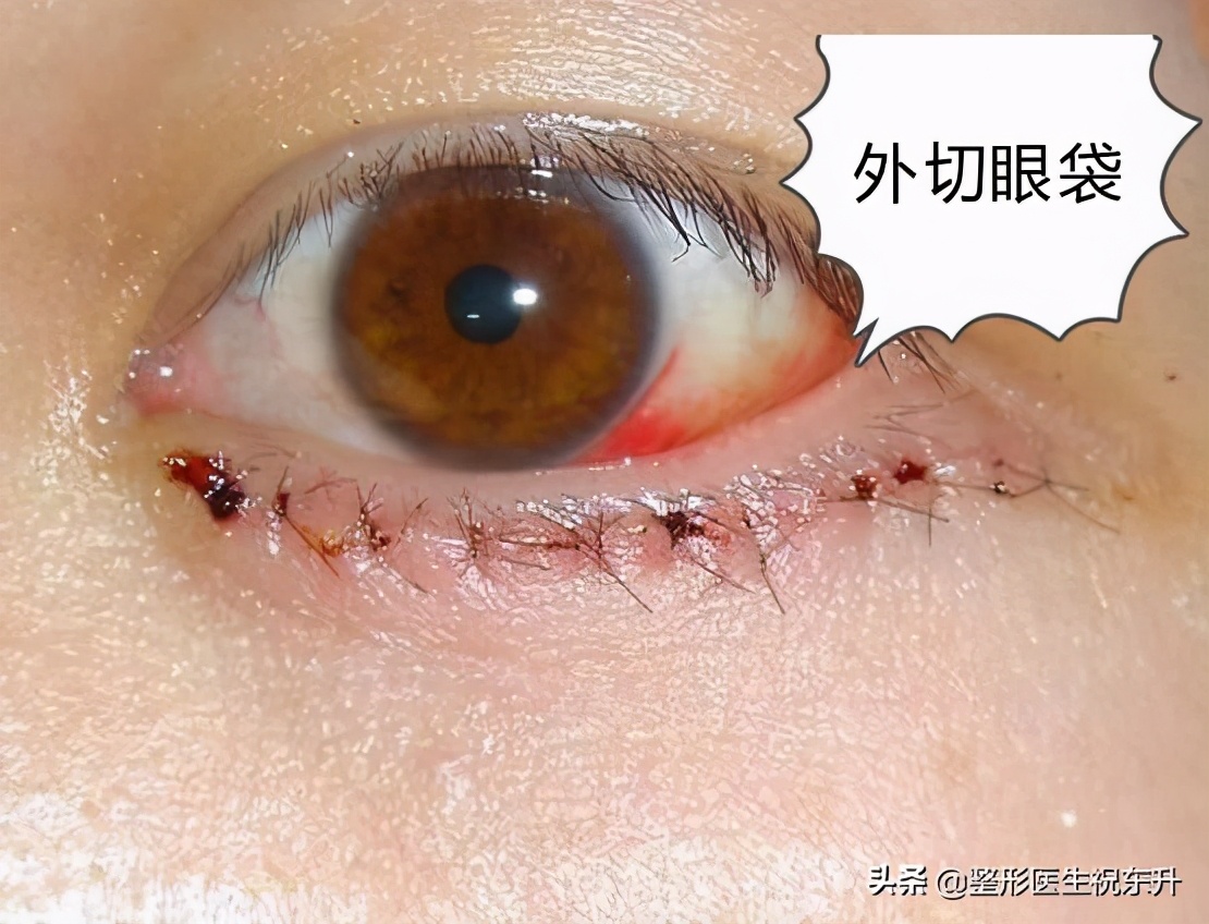 眼袋下垂松弛手术大约多少天恢复,双眼皮加眼袋手术多长时间能恢复