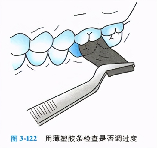 牙体缺损粘接修复术过程,口腔修复学牙体缺损的修复