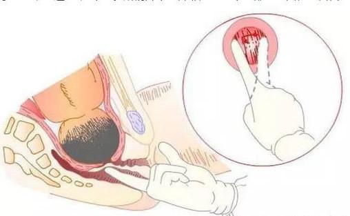 生完孩子产道会松弛吗,生完孩子产道几指正常