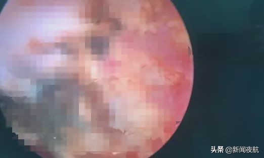 小女孩*体下**塞入异物流血不止！隔了几天走路都不对劲了