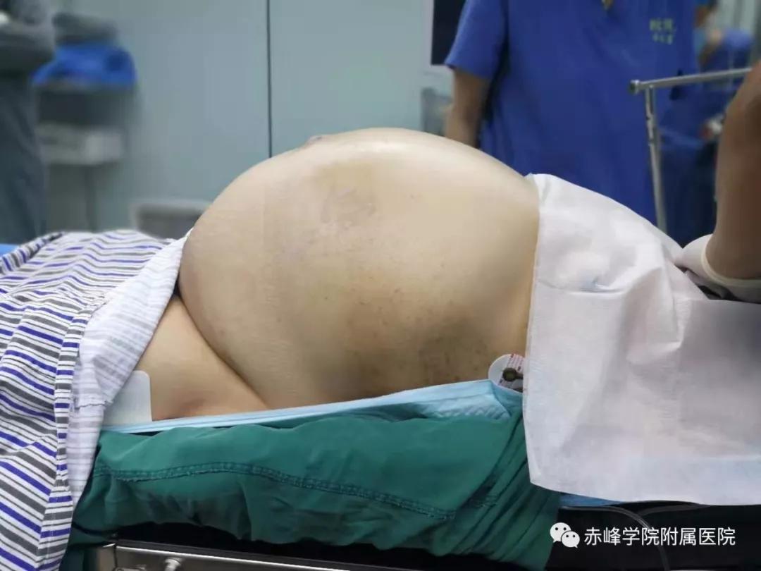 赤峰附属医院肿瘤外科,赤峰学院附属医院肿瘤