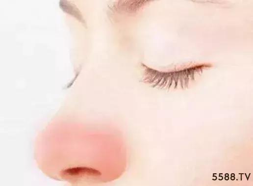 我们脸上有多少螨虫,我们脸上有虱子怎么办