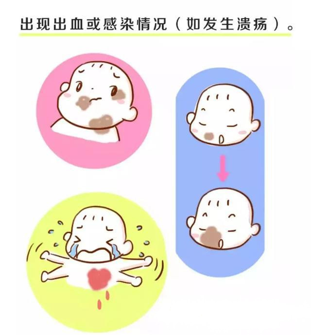 为什么宝宝出生屁股会有青胎记,宝宝出生屁股上有淤青是什么原因
