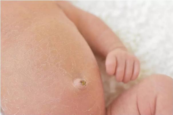 新生儿脐带消毒要用护脐带吗,脐带已经脱落了还需要消毒吗