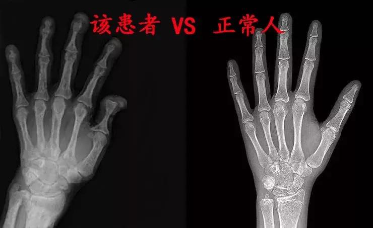 慢性肾病透析后肾还能恢复吗,慢性肾功能衰竭尿毒症透析