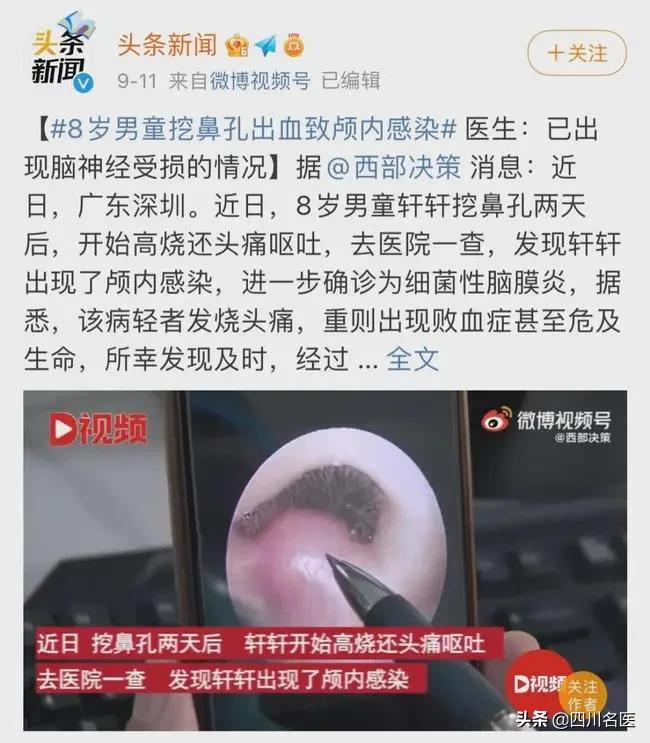 挖鼻孔太用力导致脑膜炎,挖鼻孔会导致颅内感染吗