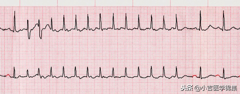 心房颤动吃什么药效果最好,阵发性心房颤动症状