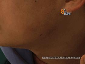 打完瘦脸针青蛙腮多久消失,打完瘦脸针出现哇噻是因为什么