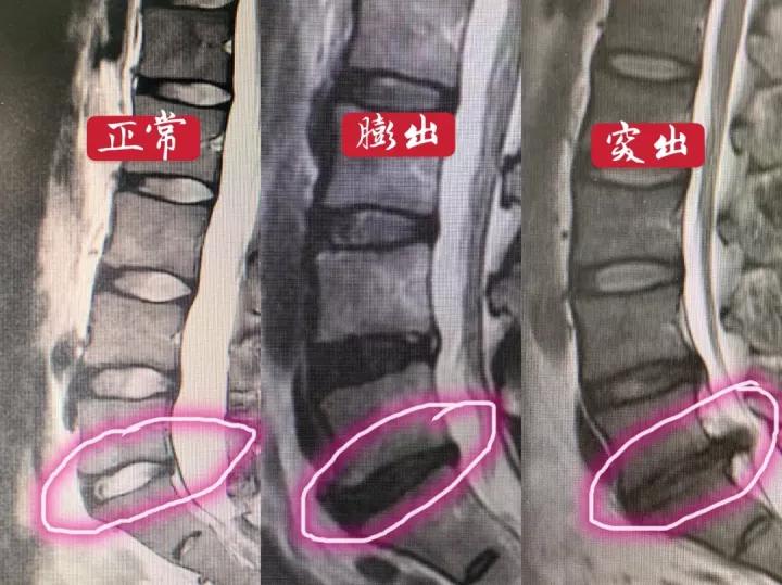 一文说清！腰椎间盘膨出、突出、脱出的区别，别再盲目开刀了