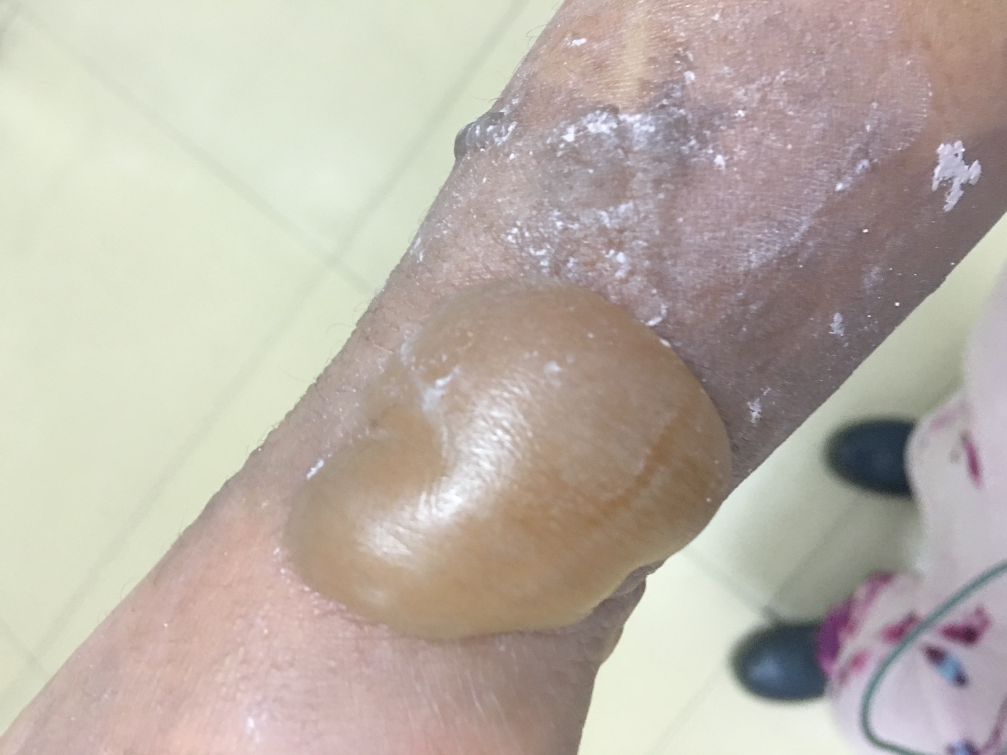 做饭被油溅伤脸怎么处理,手烫伤后能做家务吗