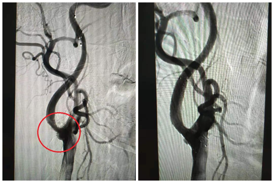 75岁老人多发性脑梗死，DSA介入治疗打通大脑“生命线”