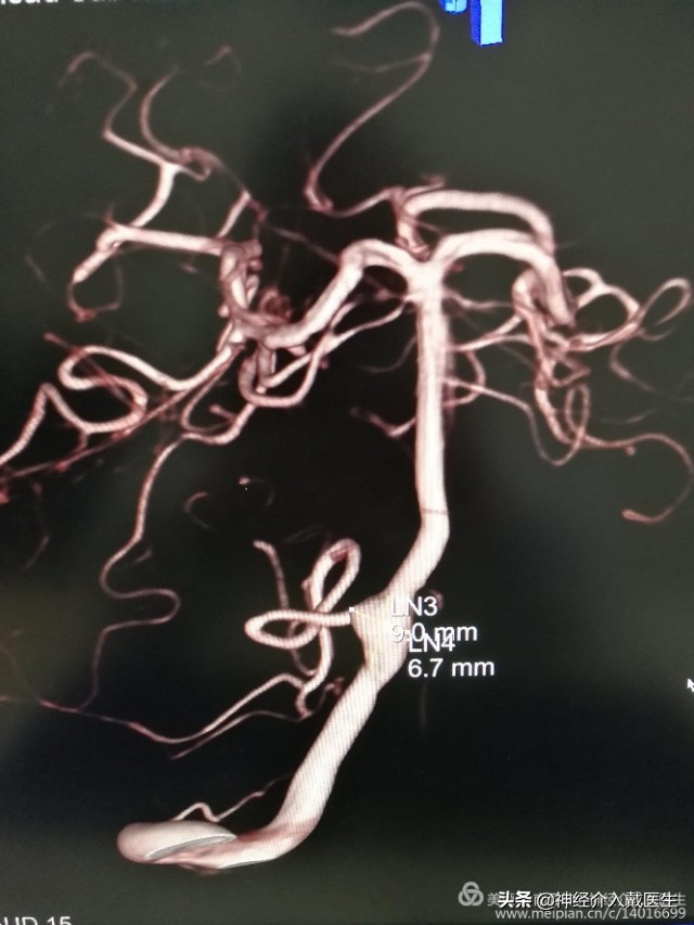 神经外科手术动脉瘤,湖南省人民医院脑动脉瘤介入治疗