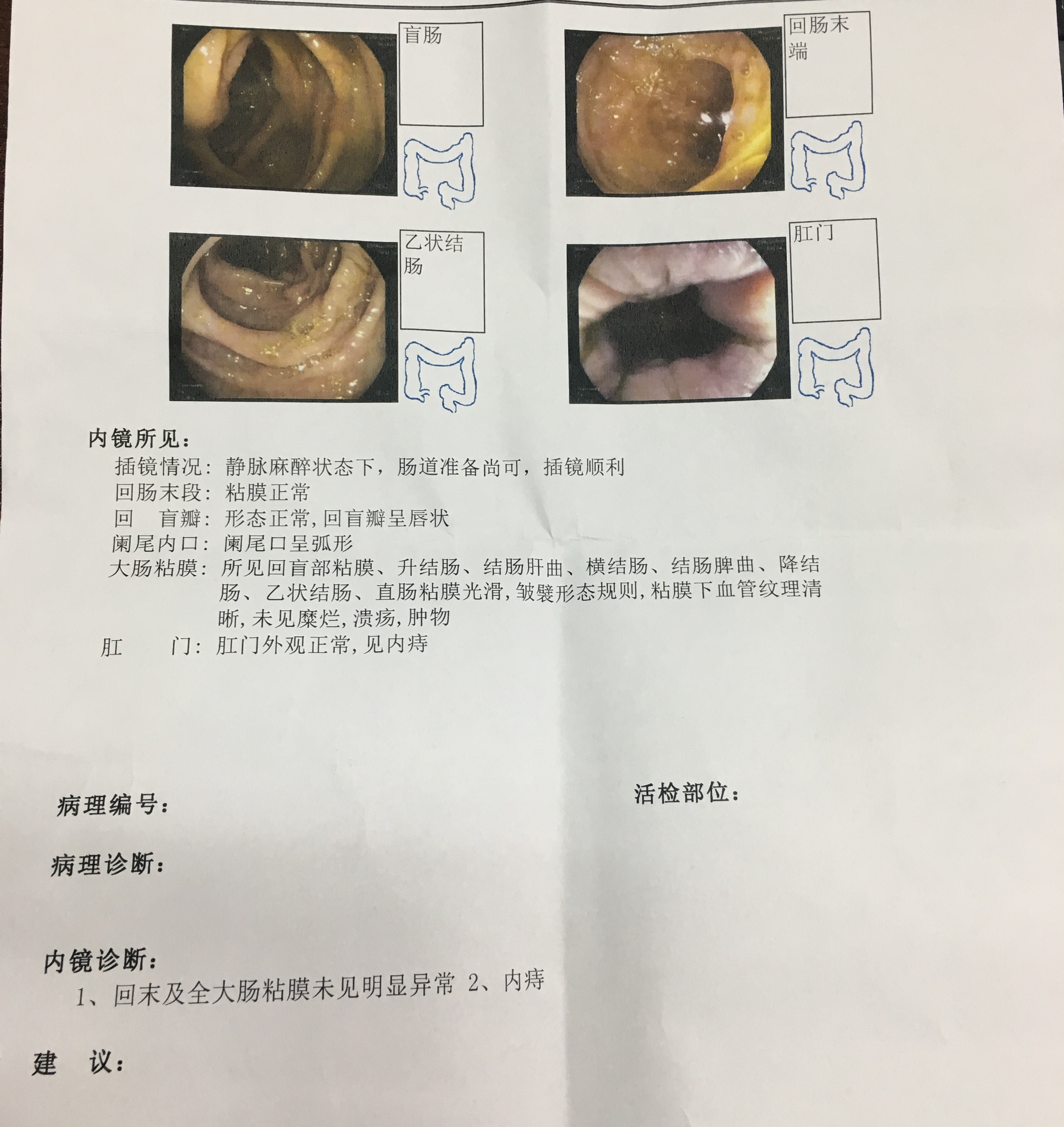 痔疮严重怎么幽默说,得了痔疮怎么办听听老医生怎么说