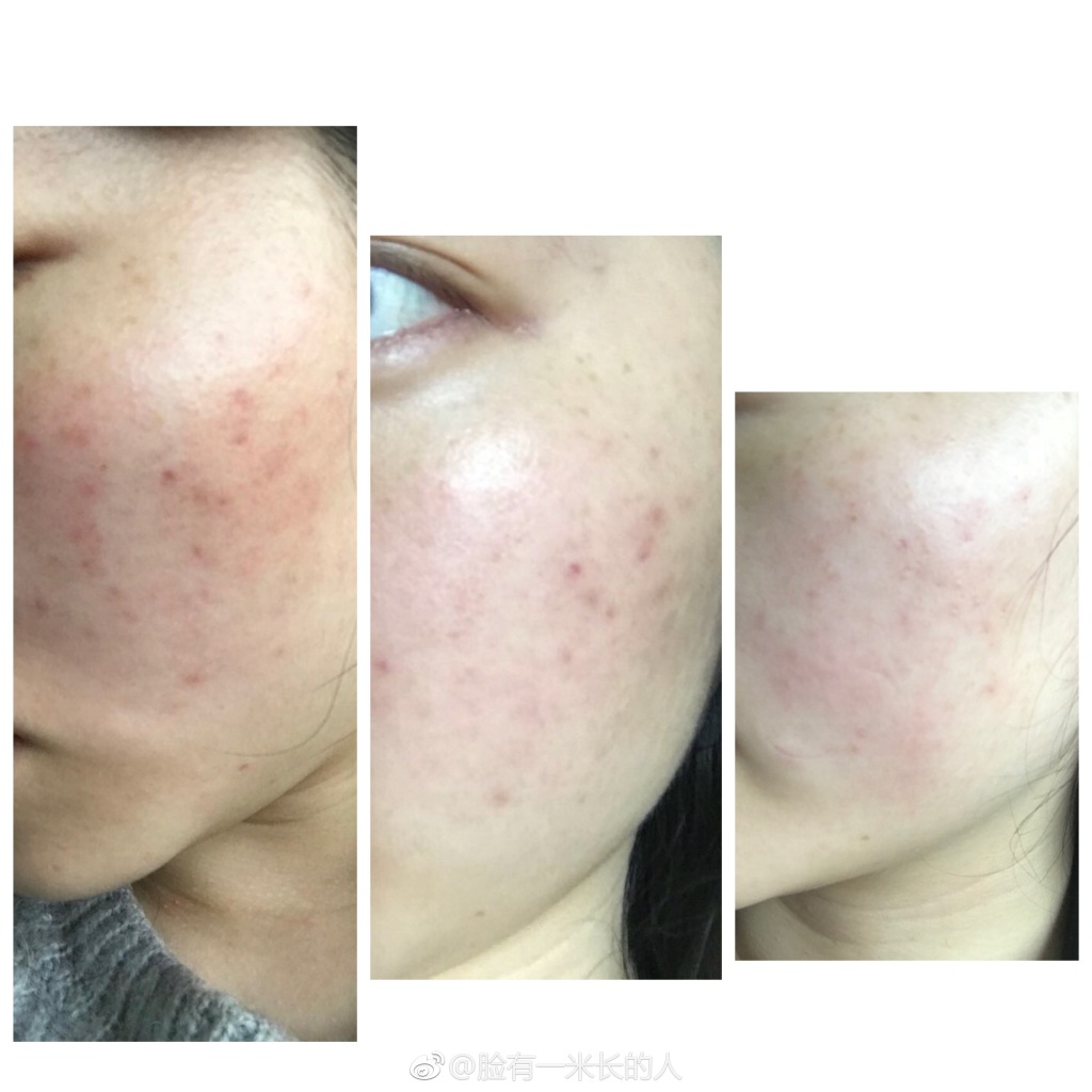 什么精华适合祛痘印和敏感肌,祛痘印的最好方法痘痘肌