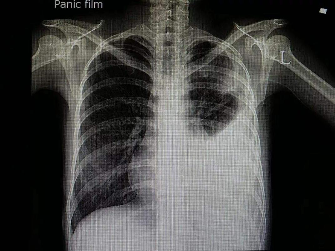 恶性肿瘤胸腔积液严重吗,恶性胸腔积液可以打药吗