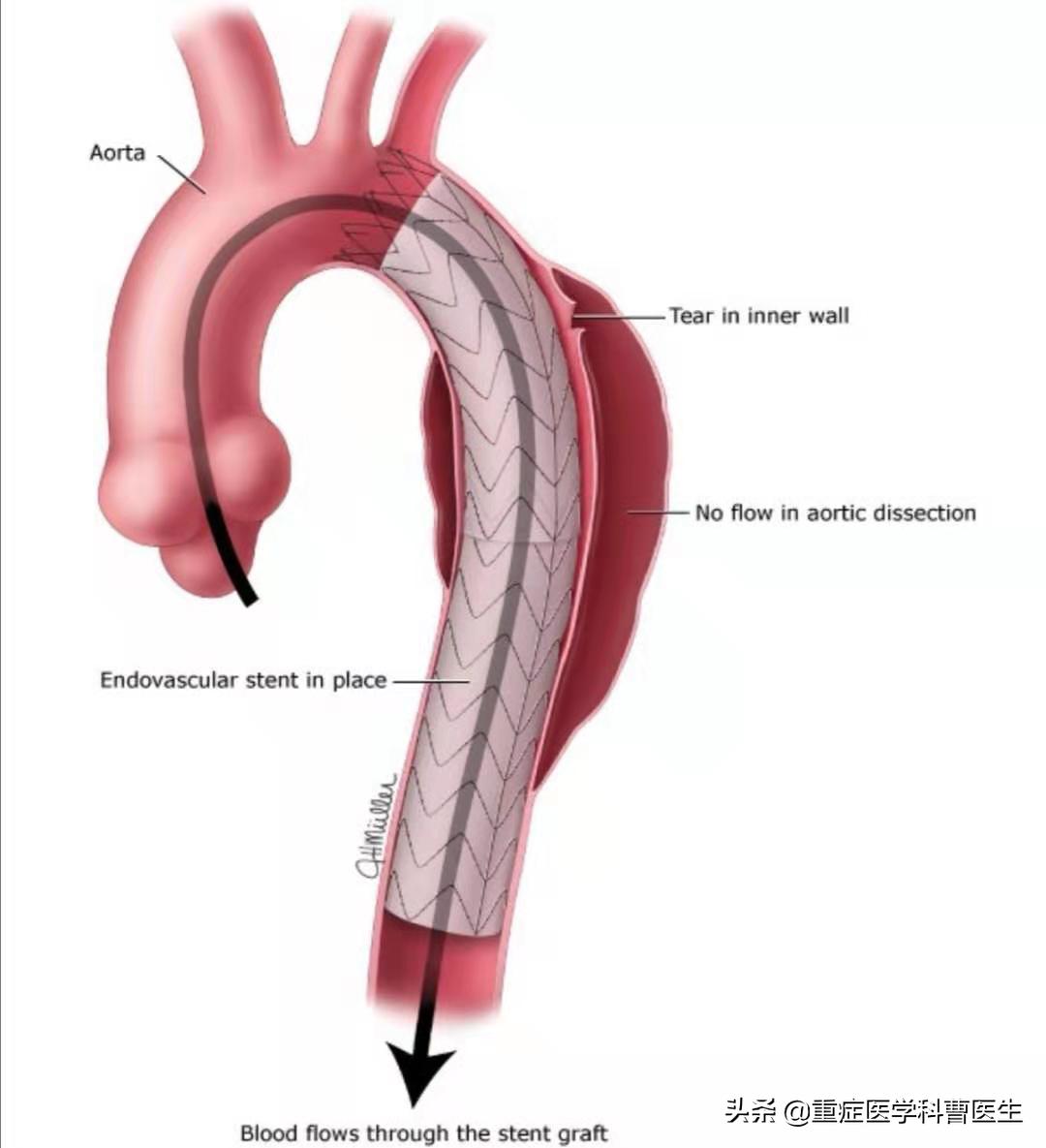 降压药不能擅自停服,降压药吃了不能吃啥