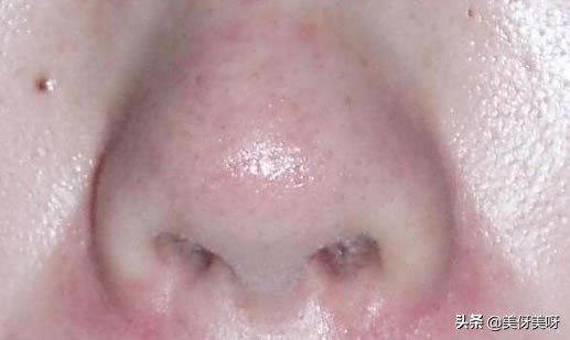 人为什么会长黑头求解：黑头白头的成因及结构和去除方法