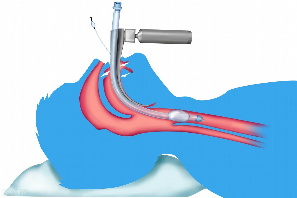气管插管与死亡,气管插管后死亡