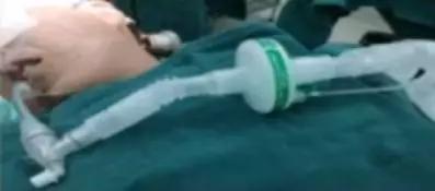 李娟教授：呼气末二氧化碳分压监测的临床应用