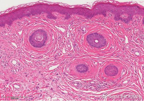 皮肤及附属器源性肿瘤,肿瘤病理诊断书