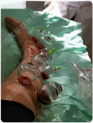 静脉曲张扎针放血成功案例,苏磊谈静脉曲张手术过程